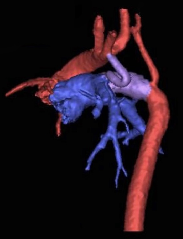 Figura 1: angiotomografia com reconstrução tridimensional demonstrando a alteração anatômica. 