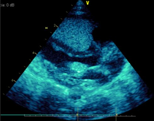 Figura 2 - Rabdomioma ocupando quase toda cavidade ventricular direita