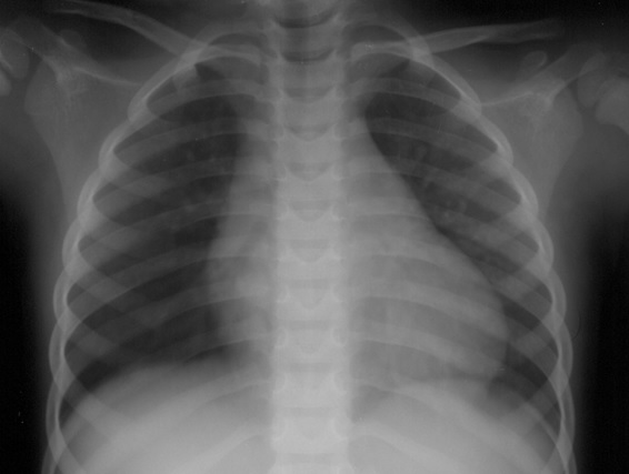 Figura 1. Rx tórax (frente), evidenciando cardiomegalia