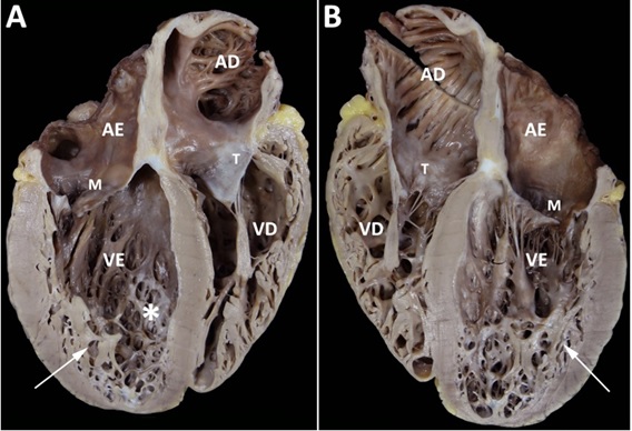 Figura 3: Peça anatômica após transplante cardíaco. 