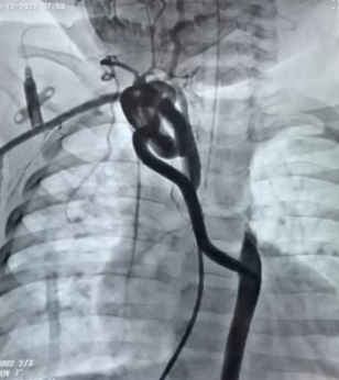 Figura 1- Cateterismo de lactente de 9 meses mostrando IAA do tipo B com colaterais para aorta torácica