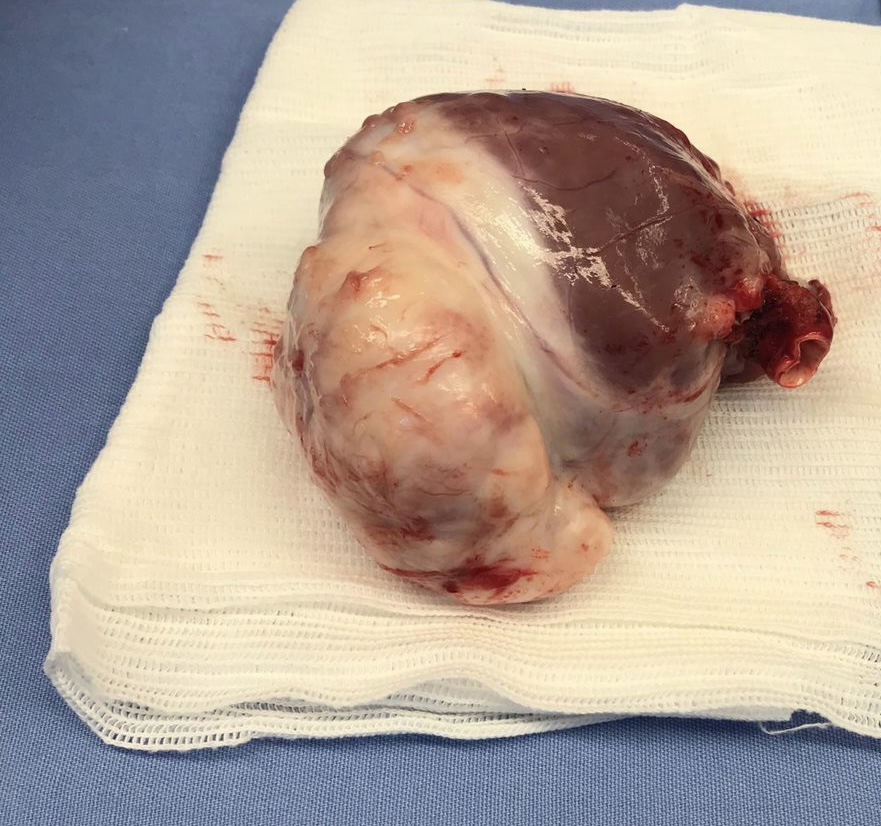 Coração explantado com Fibroma Cardíaco