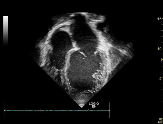 Figura 2. Imagem ecocardiográfica, apical 4 câmaras, com dilatação das cavidades cardíacas esquerdas.